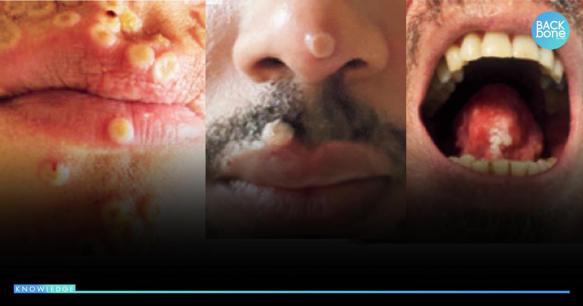 ผู้เชี่ยวชาญ ชี้..ฝีดาษวานร ยากเกินคุม 1ใน 3 พ่วง HIV หนองใน ซิฟิลิส