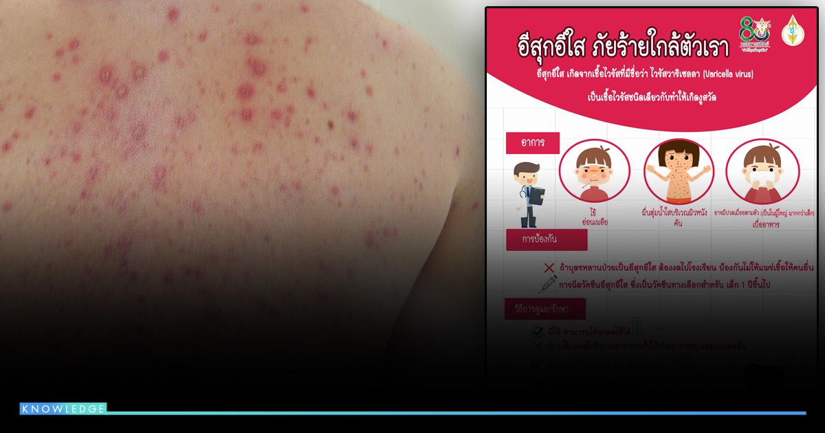 แพทย์ ย้ำเตือน ติดเชื้ออีสุกอีใส ไม่ใช้ แอสไพริน อาจถึงตาย