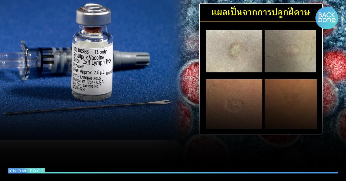หมดแล้ว !! ภูมิป้องกัน ฝีดาษวานร คนปลูกฝี-ฉีดวัคซีน 40 ปีก่อน