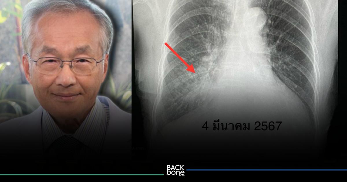 “หมอมนูญ” เตือน! “ไรโนไวรัส” ระบาดหนัก เชื้อรุนแรงเสี่ยงปอดอักเสบได้