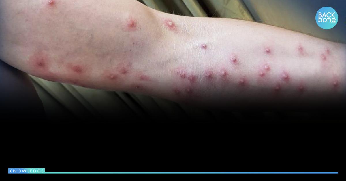 ศูนย์จีโนมฯ เผย..ฝีดาษลิง ระบาดทางอากาศได้ รับมือ อย่างไรดี ?!!